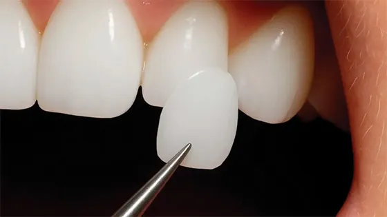 Seu novo sorriso com precisão e agilidade