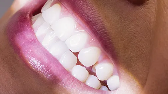 Restaurações em Resina: saúde e estética para você